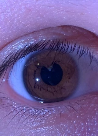 4. Mitt högra öga är lite annorlunda - men det orsakar inga märkbara synproblem.